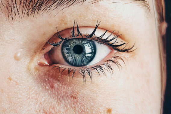 Do You Have Sebaceous Cysts?