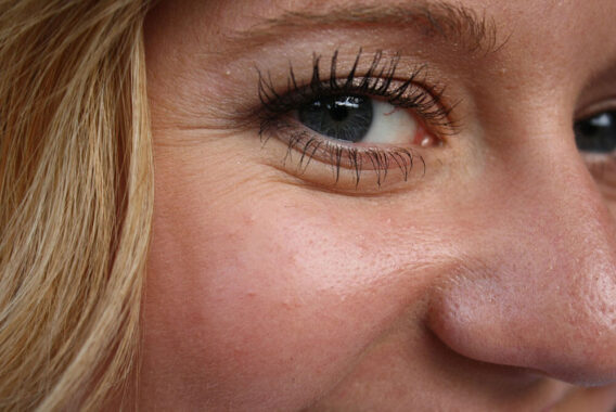 What Are Crow’s Feet and How to Fix Them