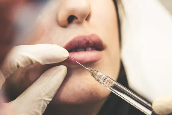 If I Get Fillers, Will It Look Natural?