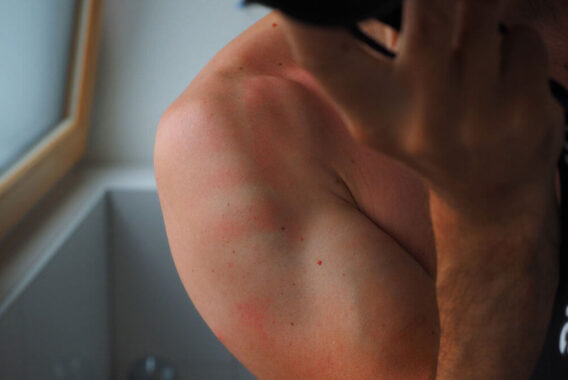 6 Best Tips for Sunburn Relief