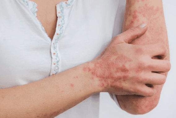 Best Treatments for Psoriasis