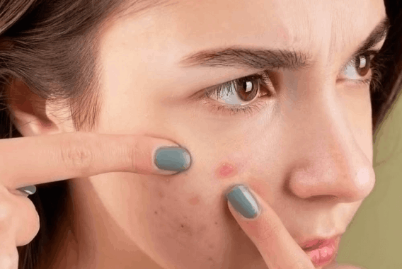 Overwhelmed By Acne? Treatment Options That Can Help