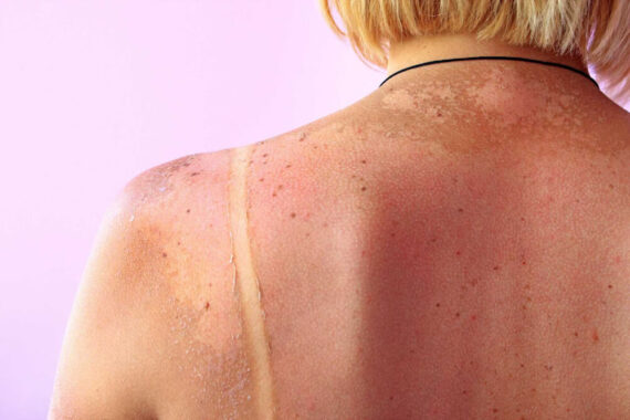 Dangerous Moles: When Is a Mole Considered a Sign of Skin Cancer?