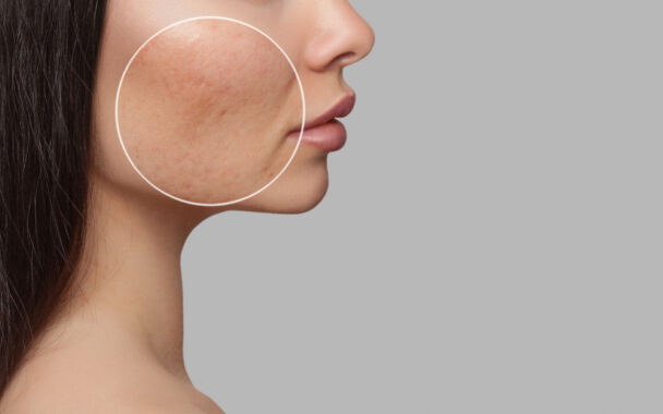 Does Laser Treatment Work Permanently for Pigmentation?