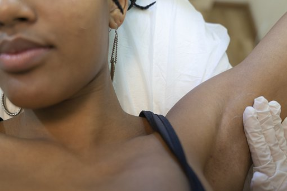 Don’t Worry About Body Hair During the Holidays. Try Laser Hair Removal