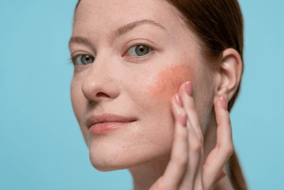 How to Properly Moisturize When You Have Rosacea