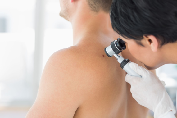 What Are the Symptoms of Skin Cancer?