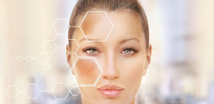 What Is the Best Treatment for Hyperpigmentation?