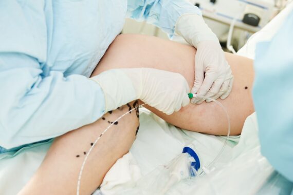 Why Varicose Veins Are Painful and What You Can Do About Them