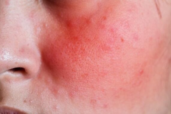 Can Your Skin Stop Reacting Positively to Certain Products?