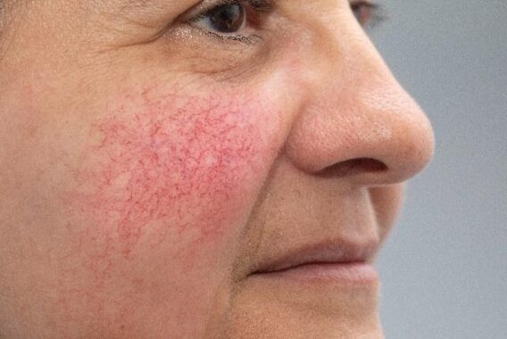 How to Protect My Skin with Rosacea in the Summer