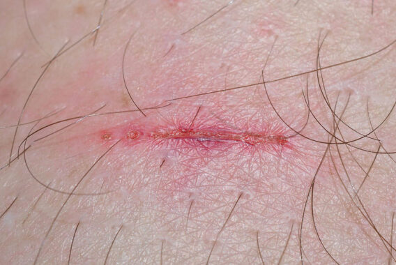 What Can I Do to Minimize Scarring?