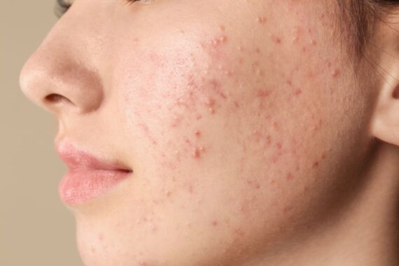 Adolescent Acne vs. Adult Acne
