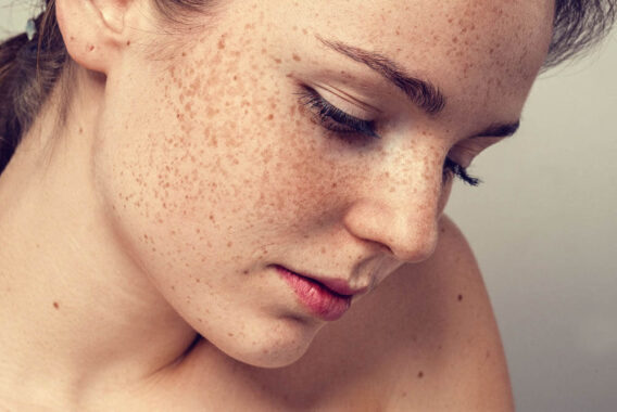 How to Combat Freckles