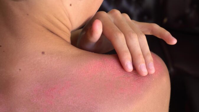 Remember Your Sunscreen This Spring Break. Here’s Why.