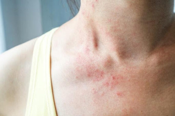 Springtime and Rashes. How to Enjoy the Sun Without the Rash
